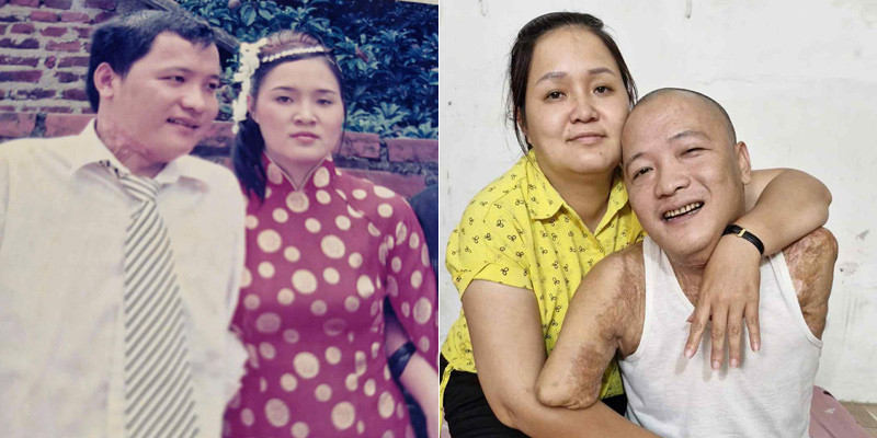 Mất 2 tay 1 chân sau tai nạn, người đàn ông tìm lại cuộc đời nhờ tình yêu của vợ - Ảnh 5.