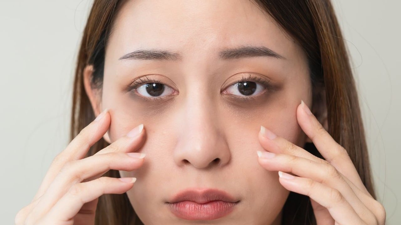 Có nhiều nguyên nhân khiến vùng da quanh mắt sạm màu. Ảnh minh họa