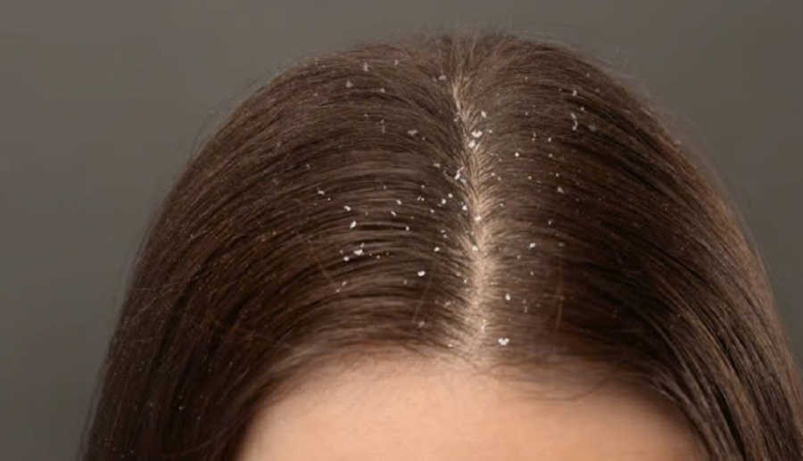 Khi gội, bạn nên làm ướt tóc hoàn toàn bằng nước mát, tạo bọt dầu gội ở tay trước rồi mới đưa lên da đầu.