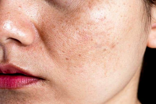 Việc chăm sóc da đúng cách và bổ sung vitamin C sẽ hỗ trợ quá trình tái tạo, giúp da sáng và đều màu hơn.